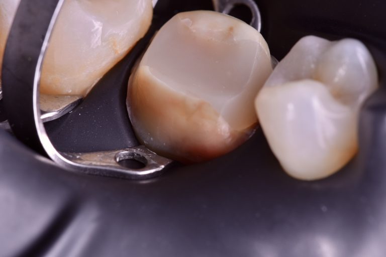 tooth filling