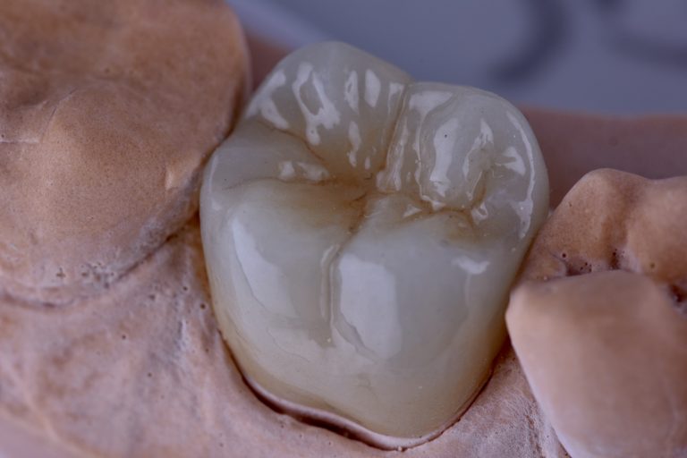 tooth filling