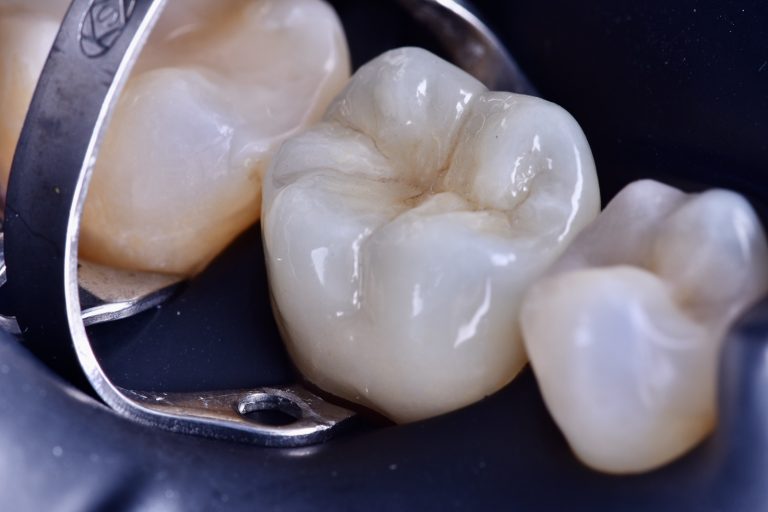 tooth filling
