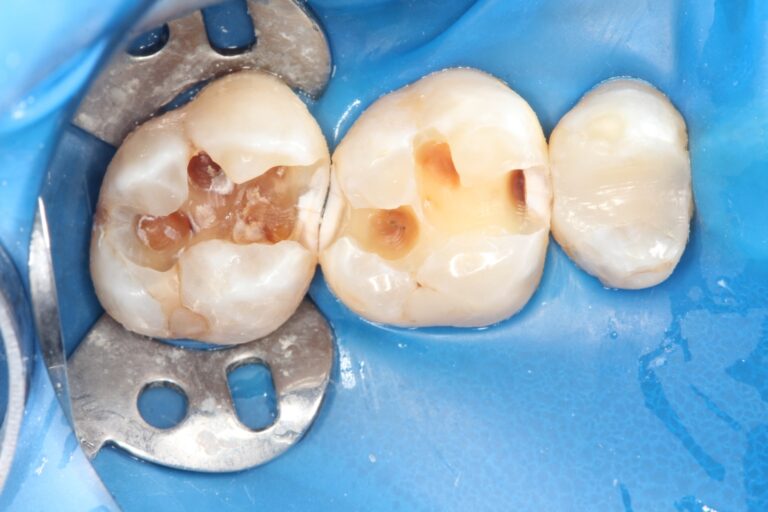 tooth filling
