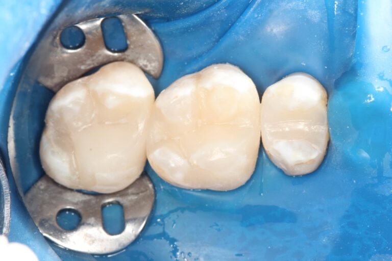 tooth filling