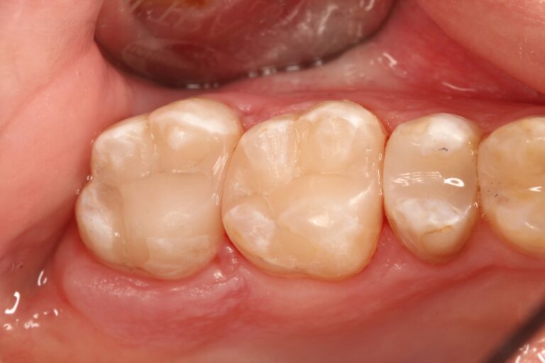 tooth filling