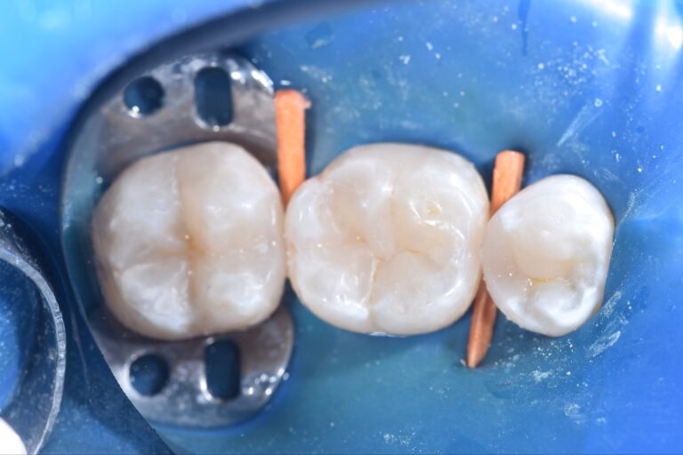 tooth filling