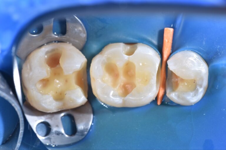 Коффердам |Стоматологія Harmonydental