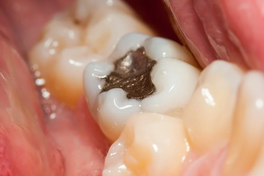 image-file-pros-and-cons-of-amalgam-filling Амальгамна пломба — стоматологія Harmony Dental