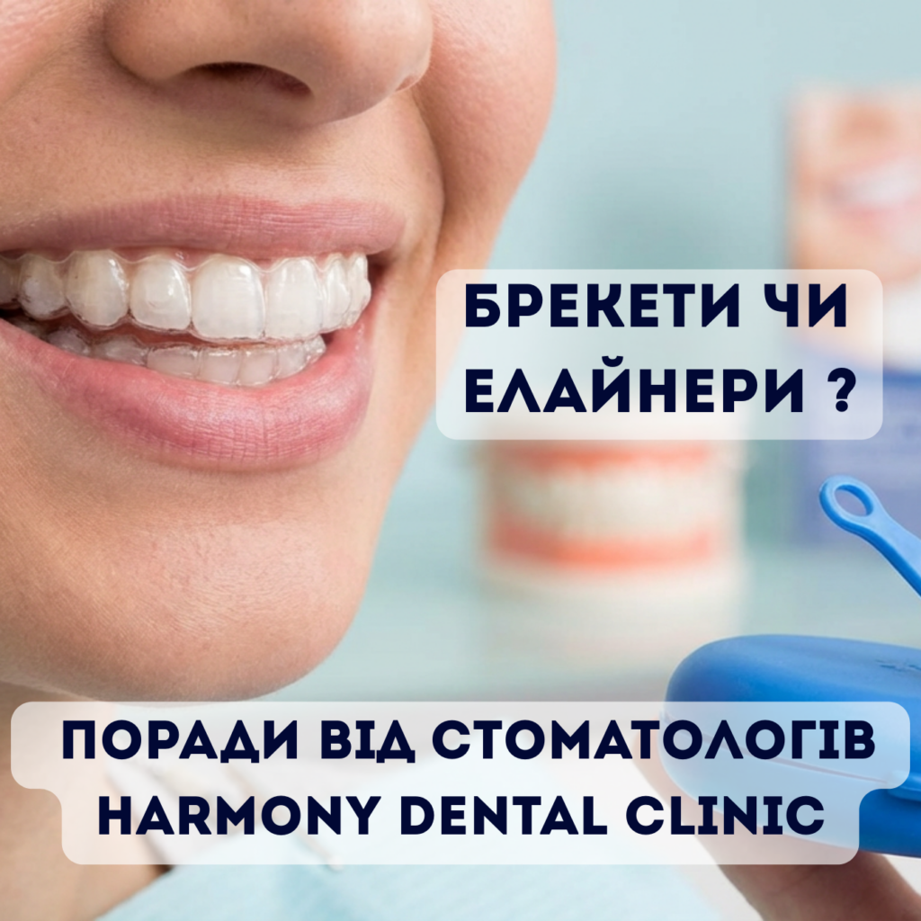 Що вибрати: брекети чи елайнери для вирівнювання зубів?